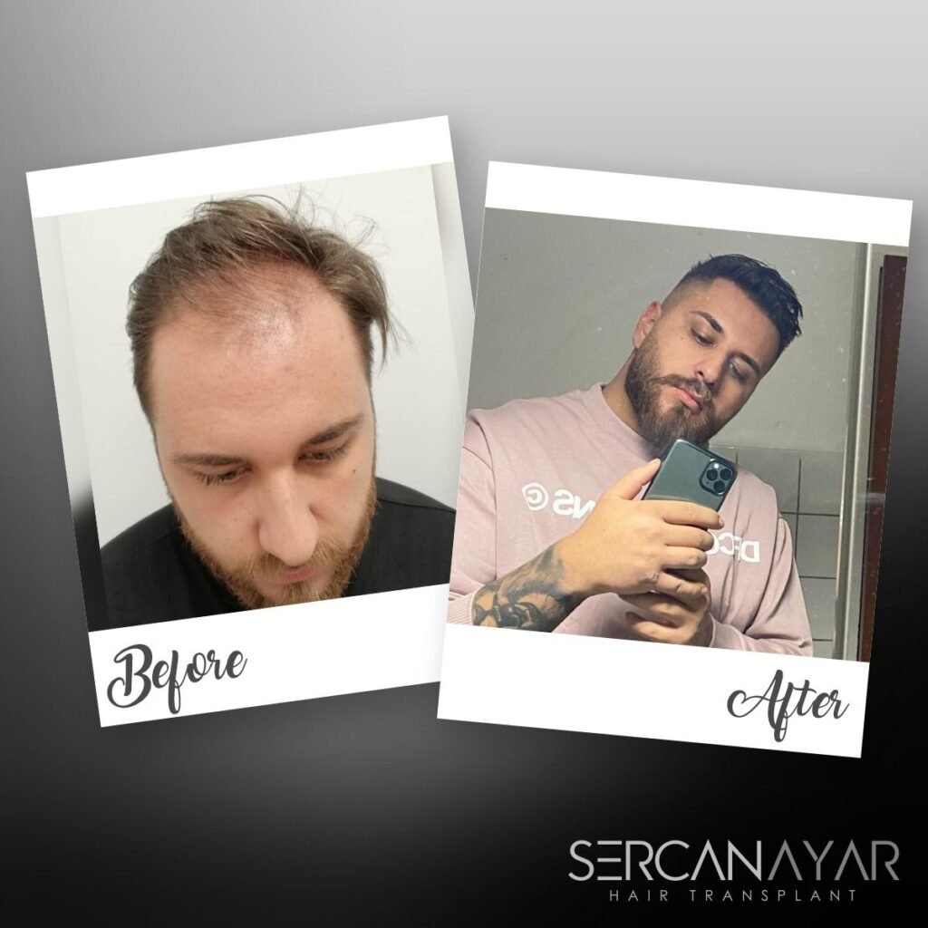 Hair Transplant after