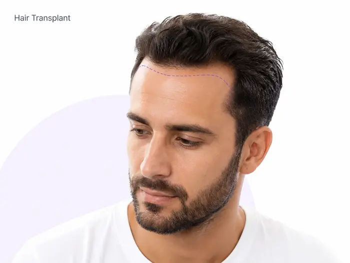 Hair Transplant