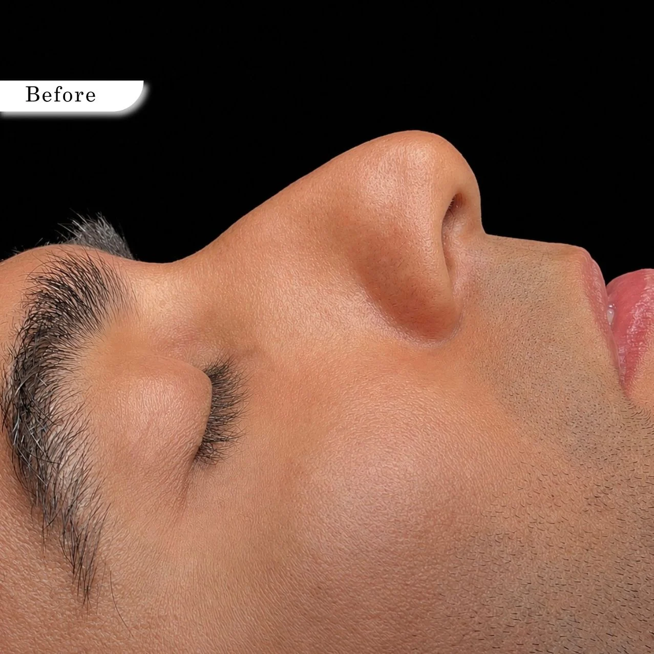 Rhinoplasty before result