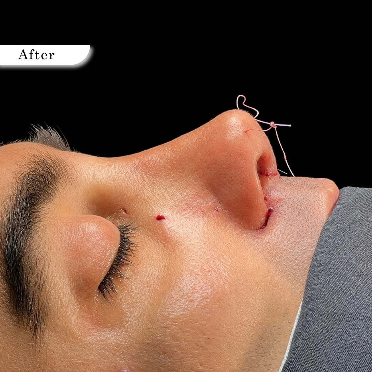 Rhinoplasty after result