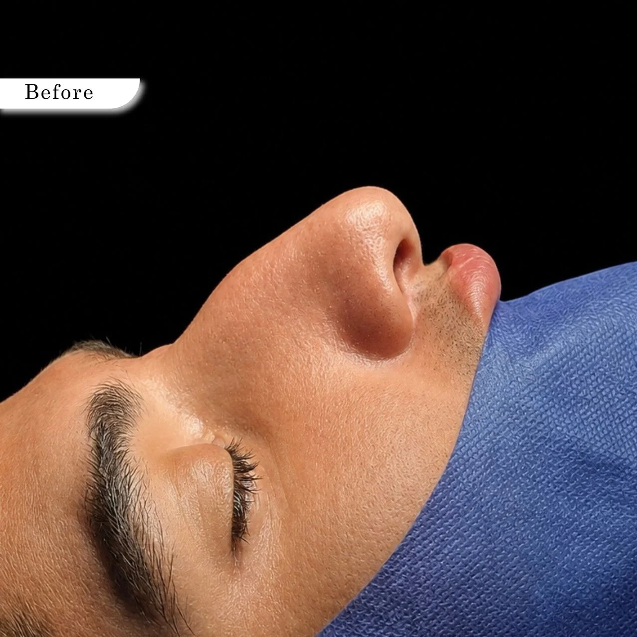 Rhinoplasty before result