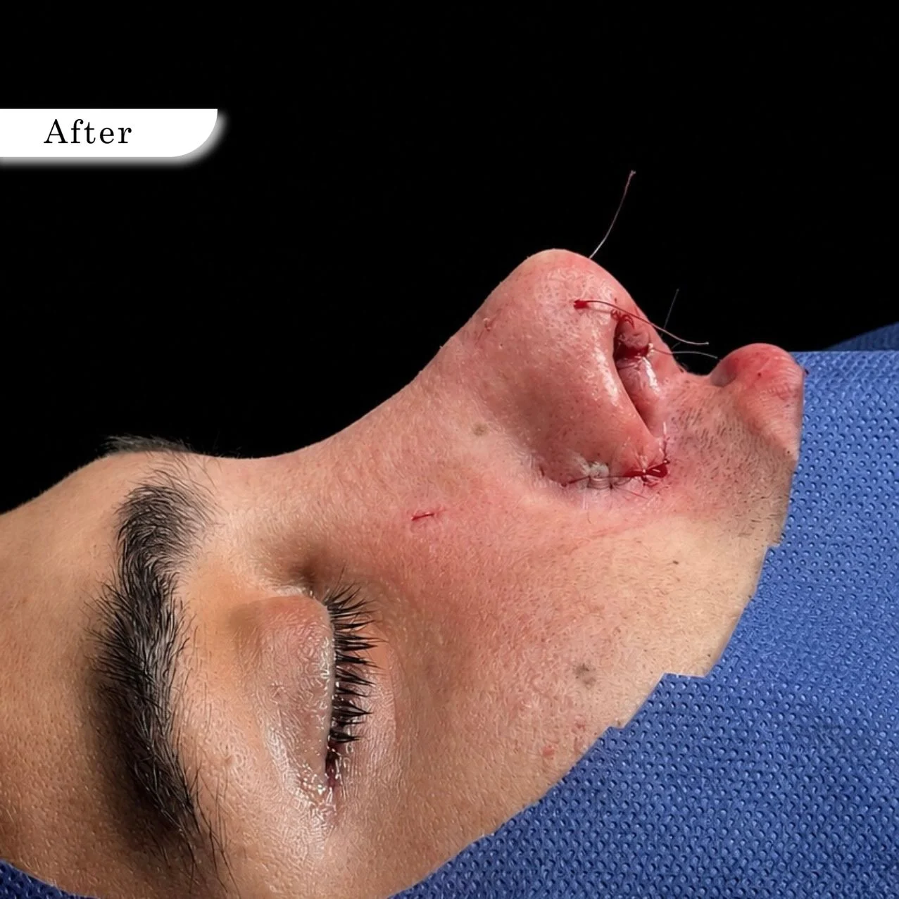 Rhinoplasty after result