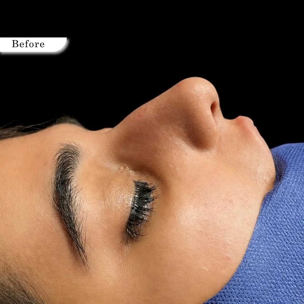 Rhinoplasty before result
