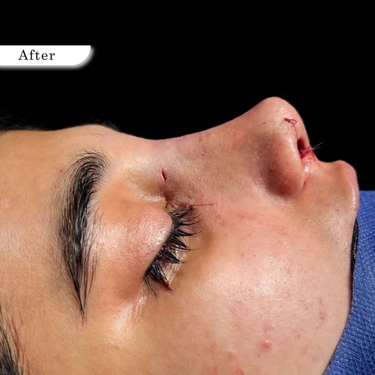 Rhinoplasty after result