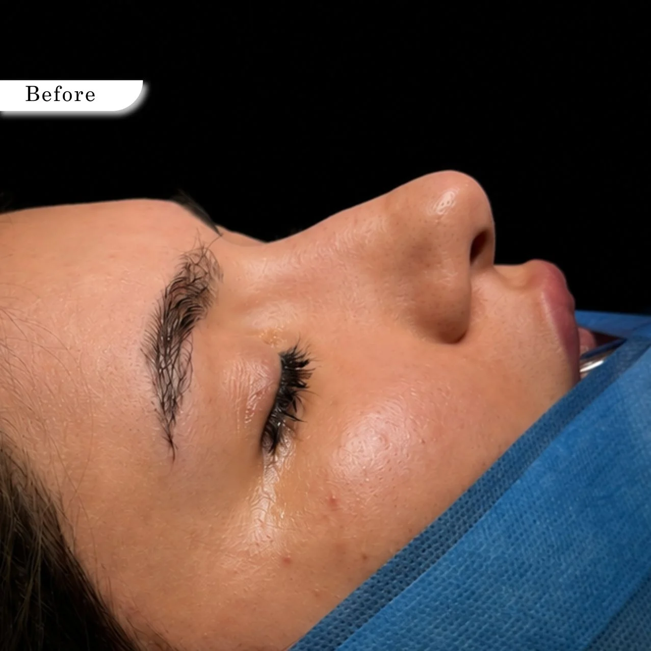 Rhinoplasty before result