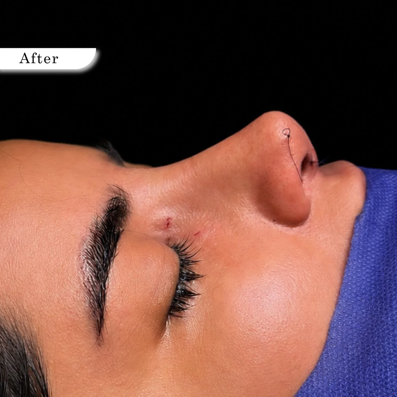 Rhinoplasty after result