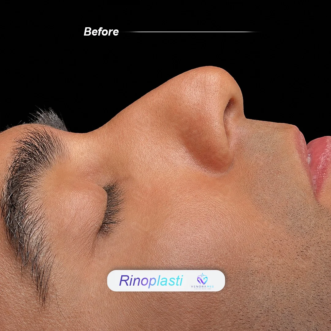 Rhinoplasty before result