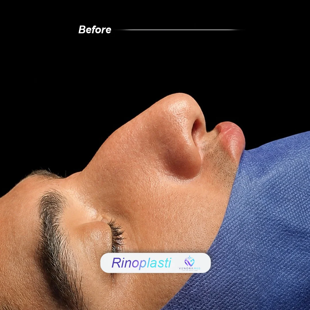 Rhinoplasty after result