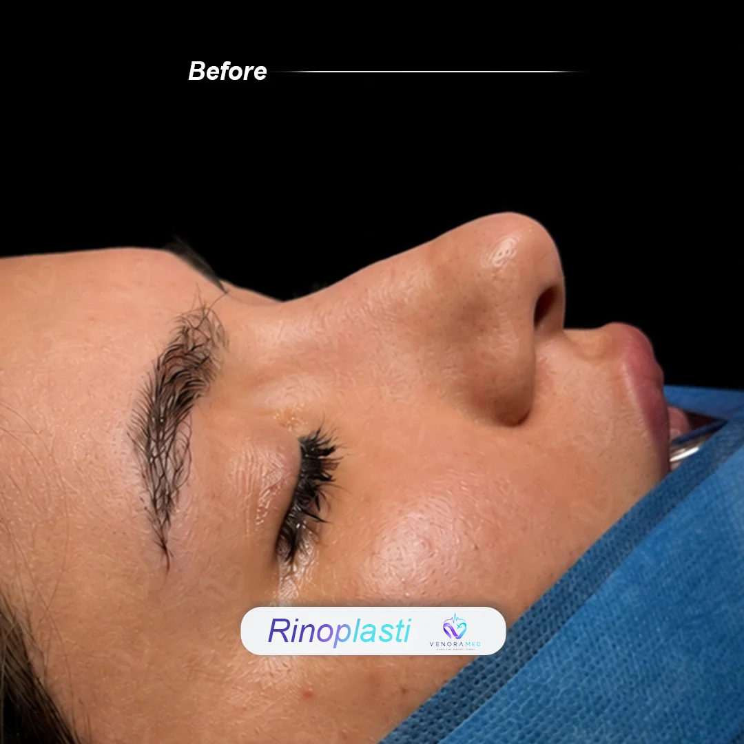 Rhinoplasty before result
