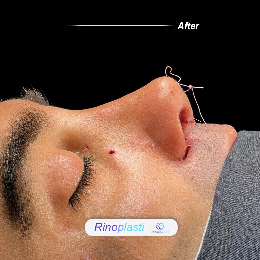 Rhinoplasty after result