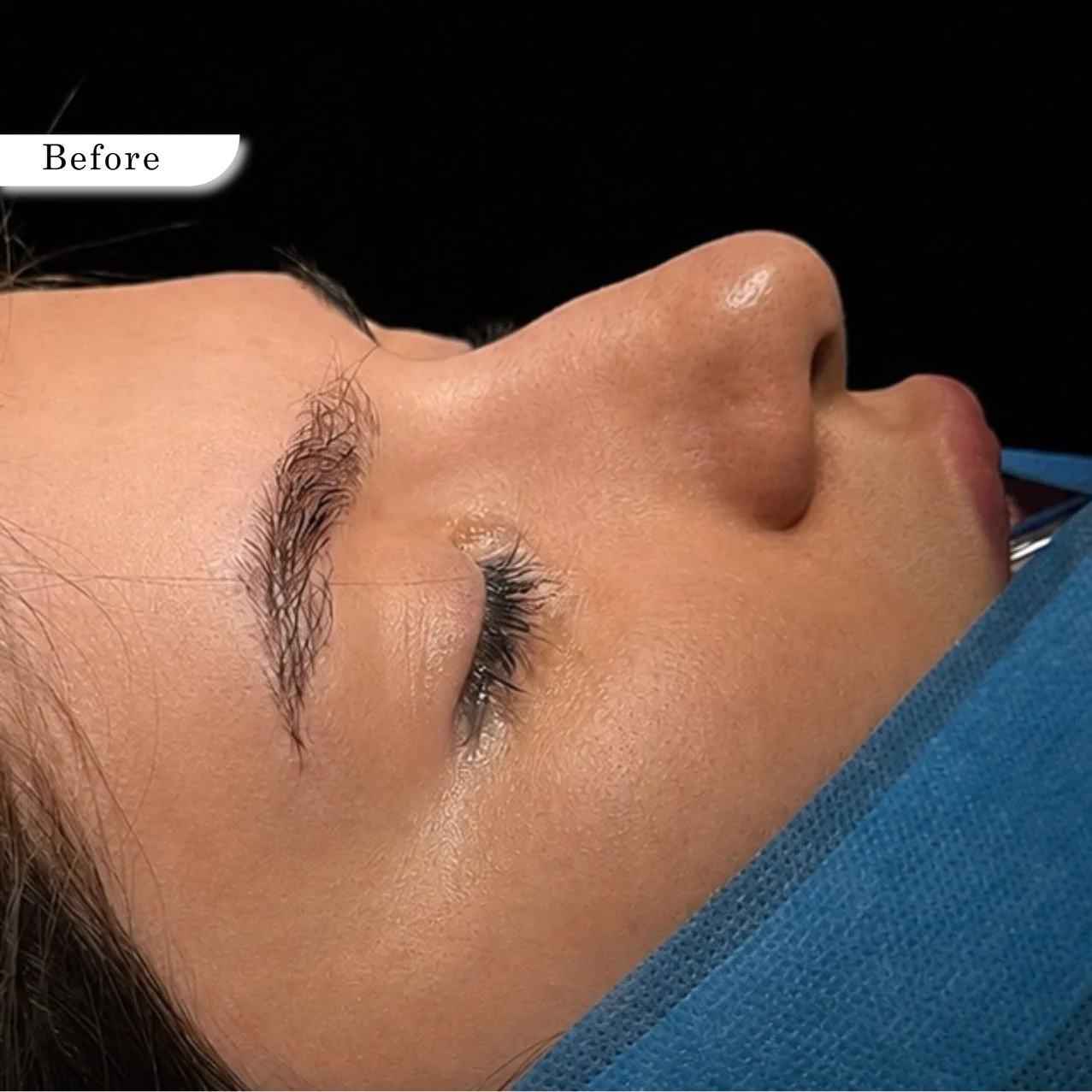Rhinoplasty before result
