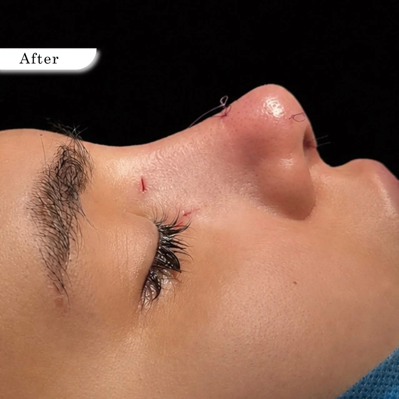 Rhinoplasty after result