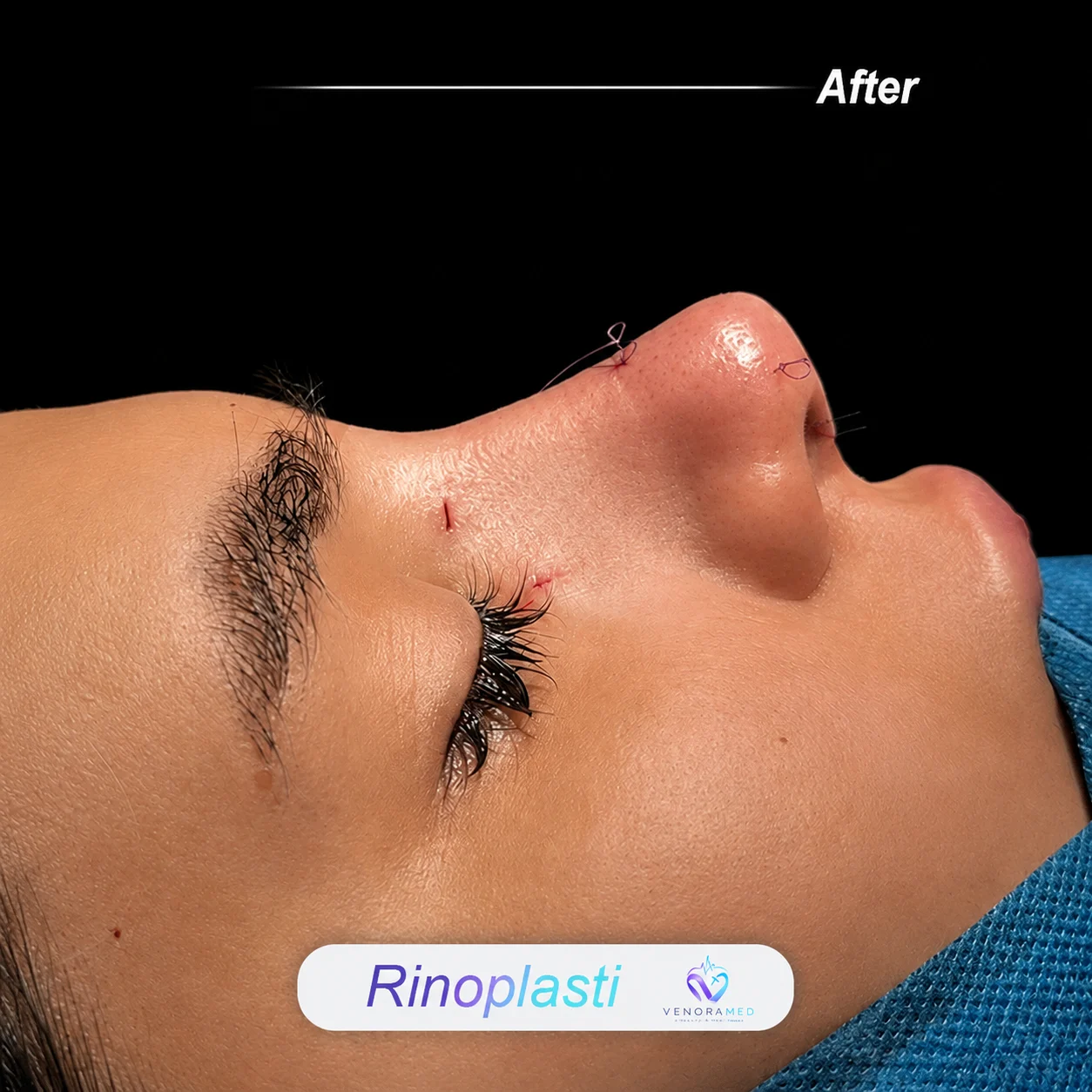 Rhinoplasty after result