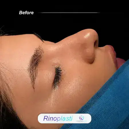 Rhinoplasty before result