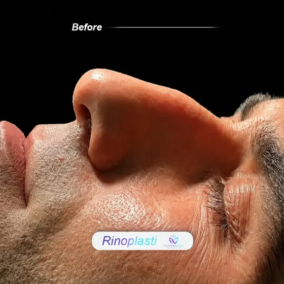 Rhinoplasty before result