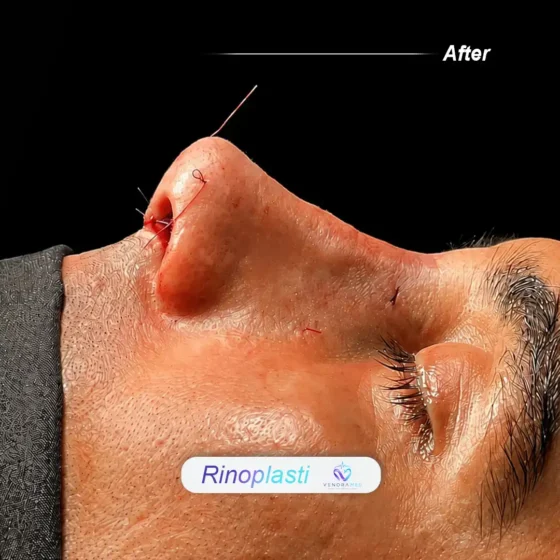 Rhinoplasty after result