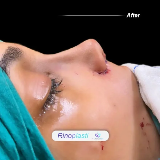 Rhinoplasty after result