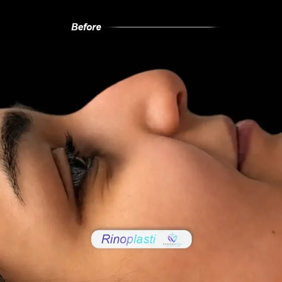 Rhinoplasty before result