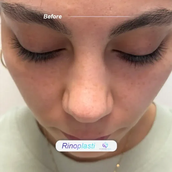 Rhinoplasty before result