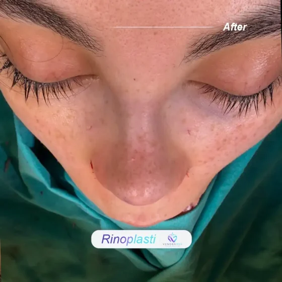 Rhinoplasty after result