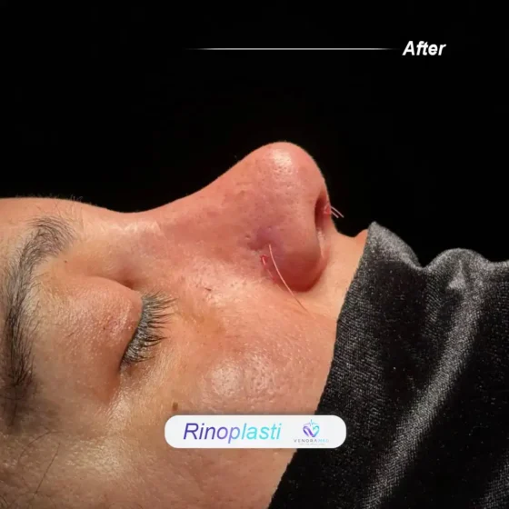 Rhinoplasty after result