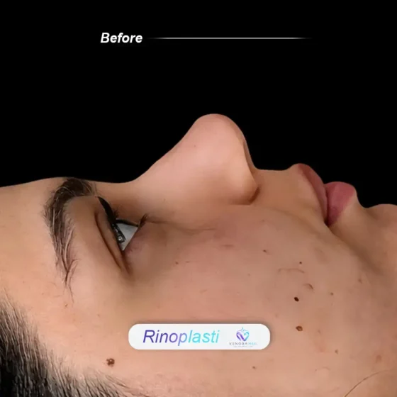 Rhinoplasty before result